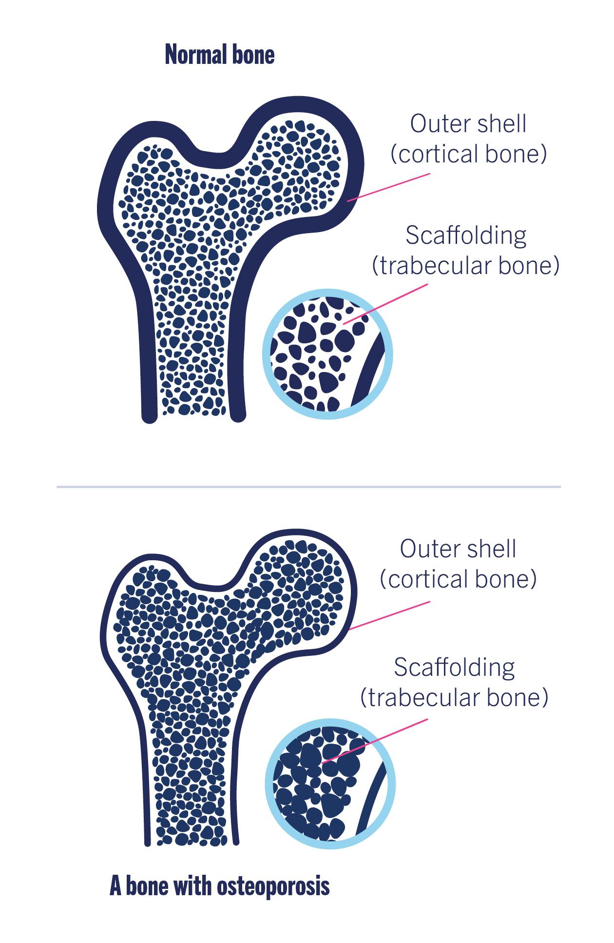 An illustration comparing a normal bone with a bone with osteoporosis